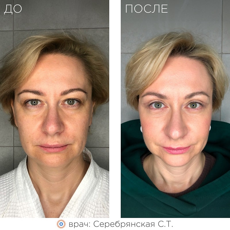 Круговая блефаропластика с перераспределением грыжевых пакетов и миопексией