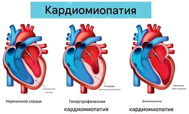 Кардиомиопатия сердца Кардиомиопатия сердца
