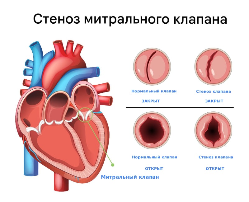 Стеноз митрального клапана Стеноз митрального клапана