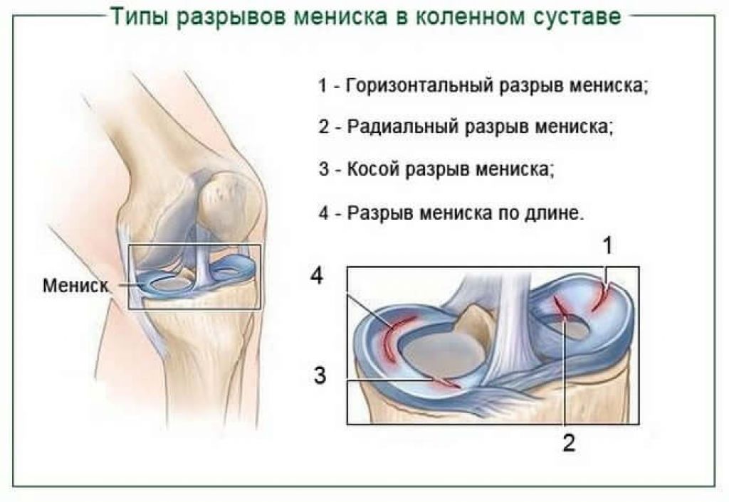 лечение мениска коленного сустава симптомы и фото