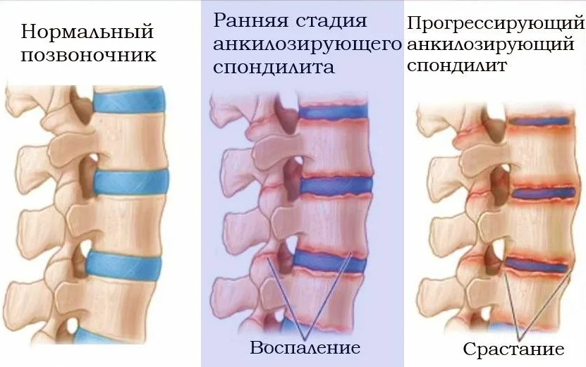 Болезнь Бехтерева (анкилозирующий спондилит): симптомы, диагностика и лечение в Санкт-Петербурге