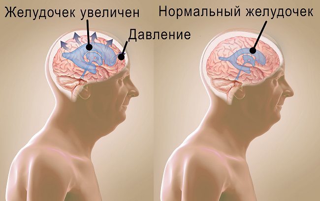 Гидроцефалия, или водянка головного мозга