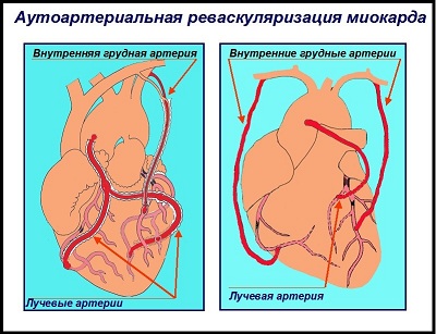 Аортокоронарное шунтирование презентация