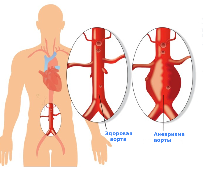 Аневризма брюшной полости