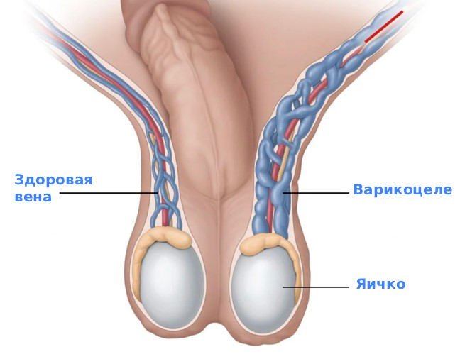 Варикоцеле у мужчин