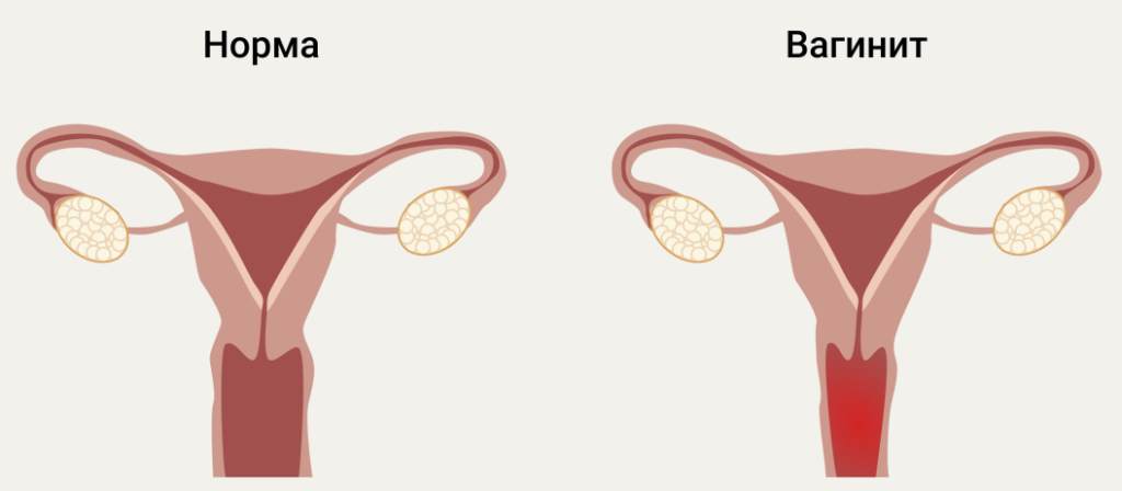 Лечение бактериального вагиноза и почему он возникает - блог маммологического центра L7