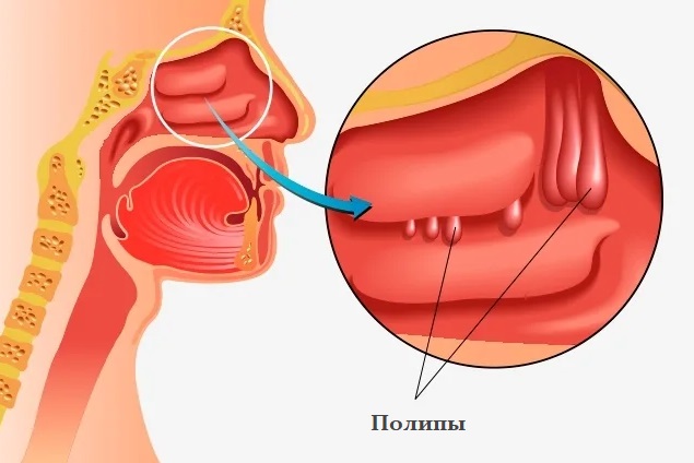 Удаление полипов в носу (полипотомия)