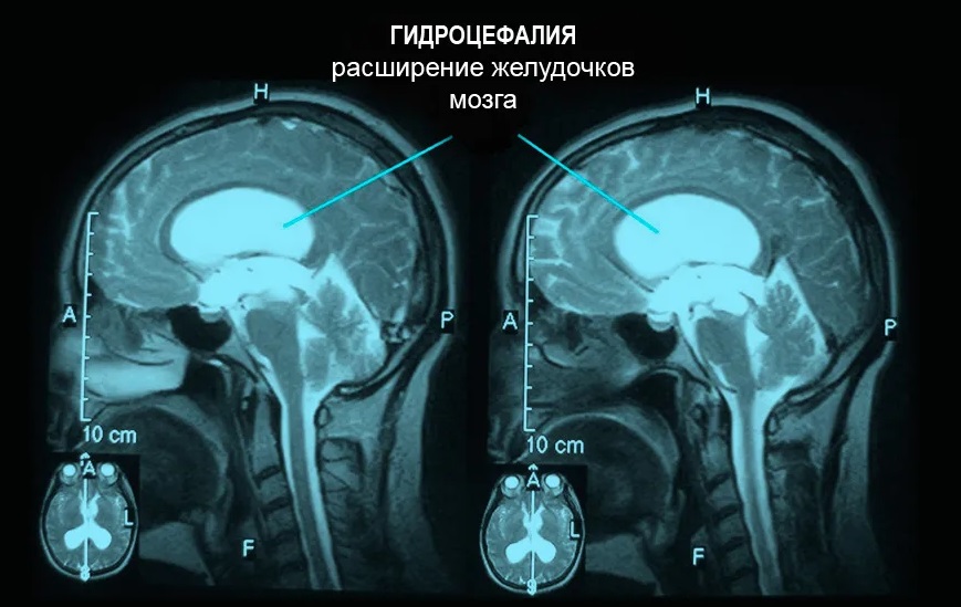 гидроцефалия мозга