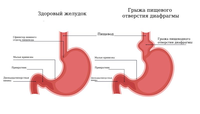 Грыжа пищеводного отверстия диафрагмы