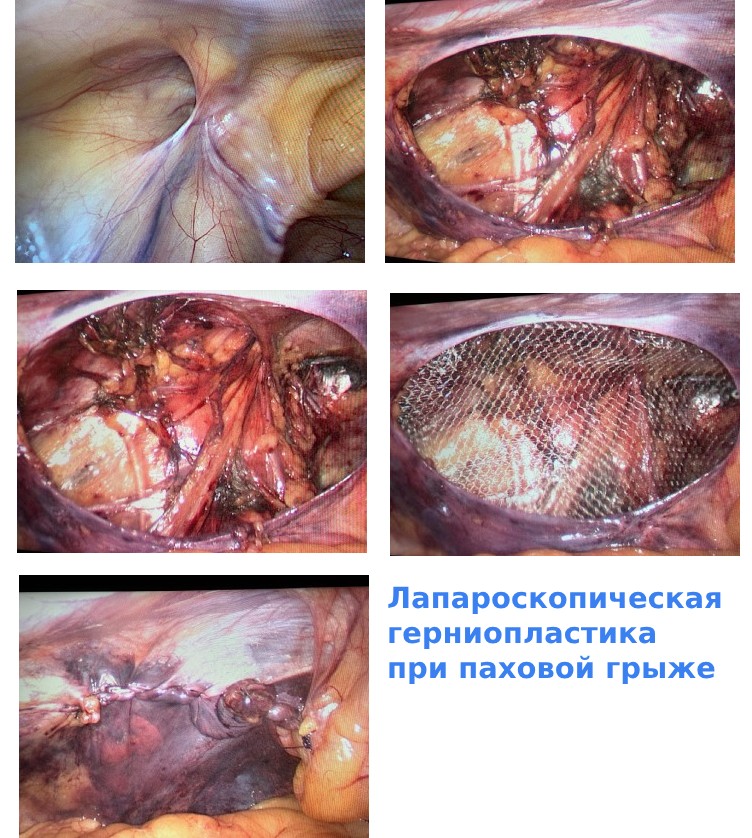 Лапароскопическая герниопластика