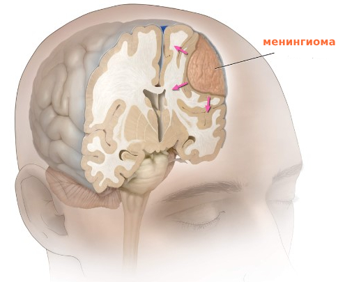 Менингиома в голове что это такое
