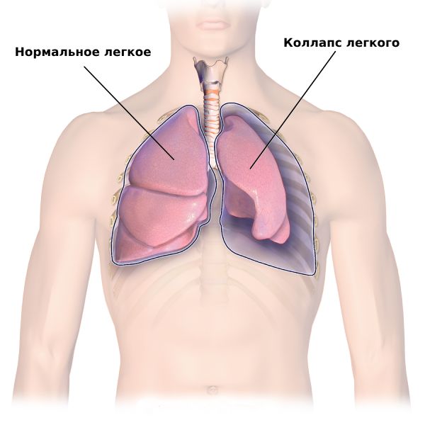 Пневмоторакс легких что это