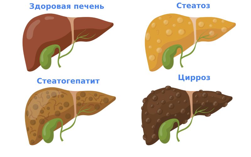 Цирроз печени стадии