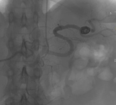 Аневризма селезеночной артерии лечение