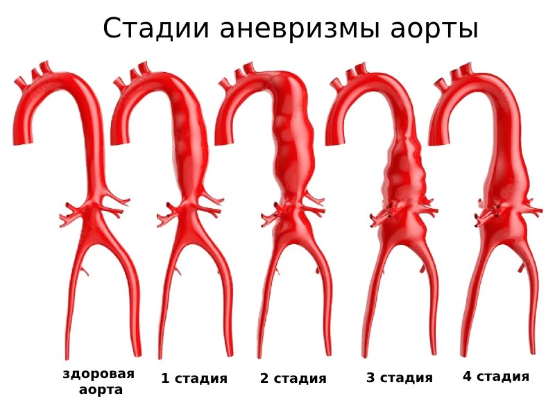 Классификация аневризм аорты