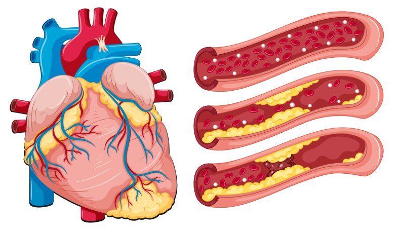 Атеросклероз сосудов сердца