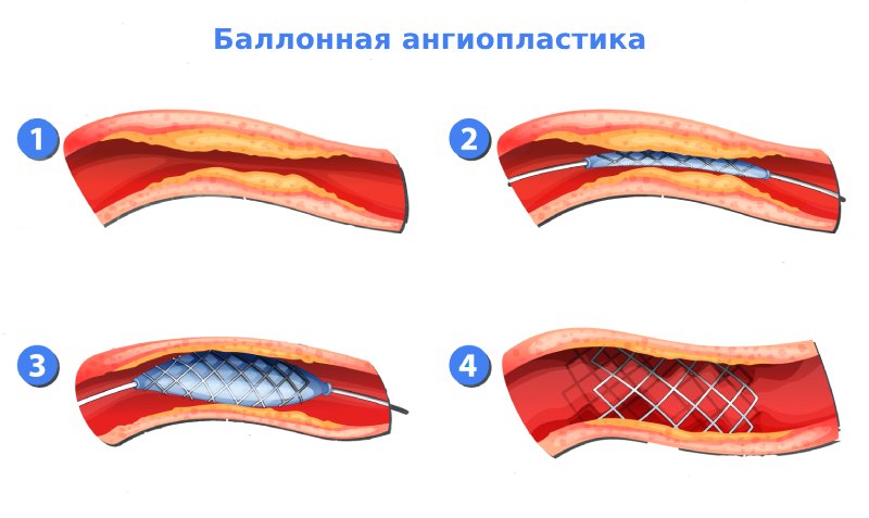 Баллонная ангиопластика артерий нижних конечностей