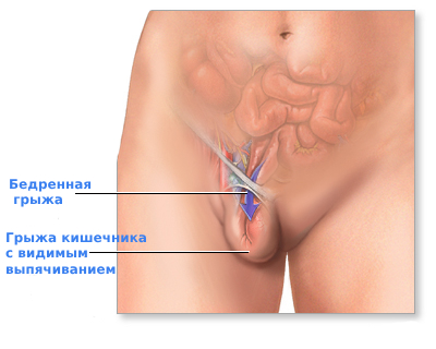 Бедренная грыжа у женщин