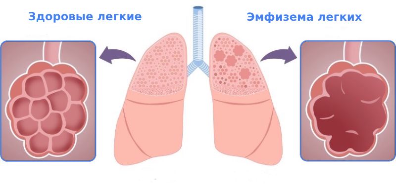 Эмфизема легких что это такое