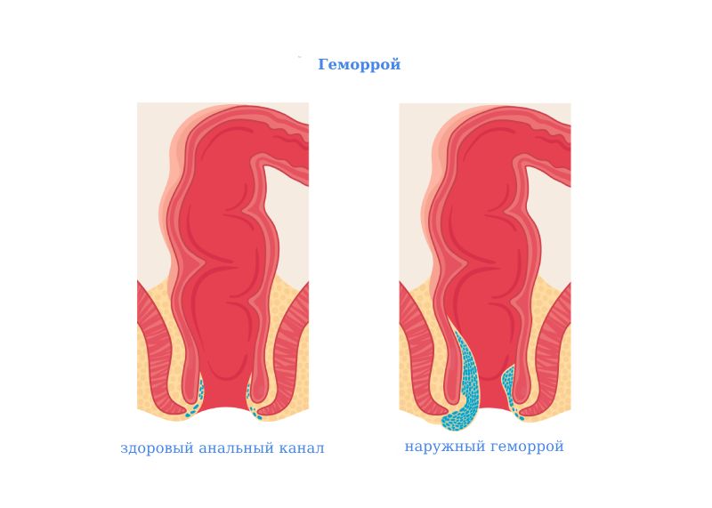 Как вылечить геморрой