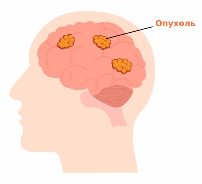 Глиома в головном мозге