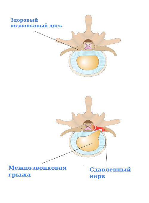 Грыжа межпозвоночного диска шейного отдела