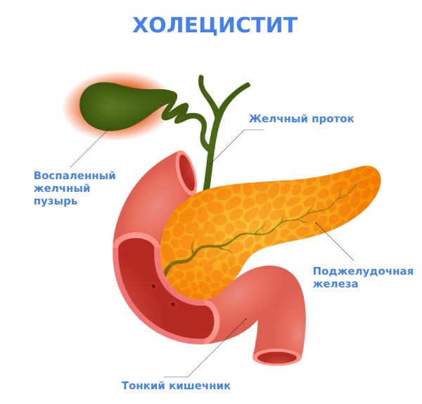 Холецистит симптомы и лечение у женщин