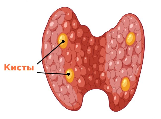Кисты щитовидки