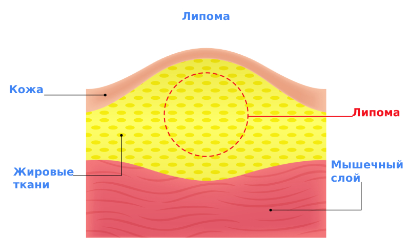 Симптомы липомы