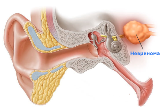 Невринома слухового нерва