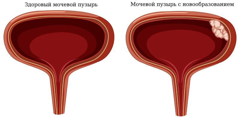 Новообразования мочевого пузыря