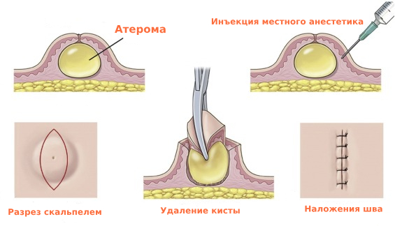 Удаление атеромы в Москве