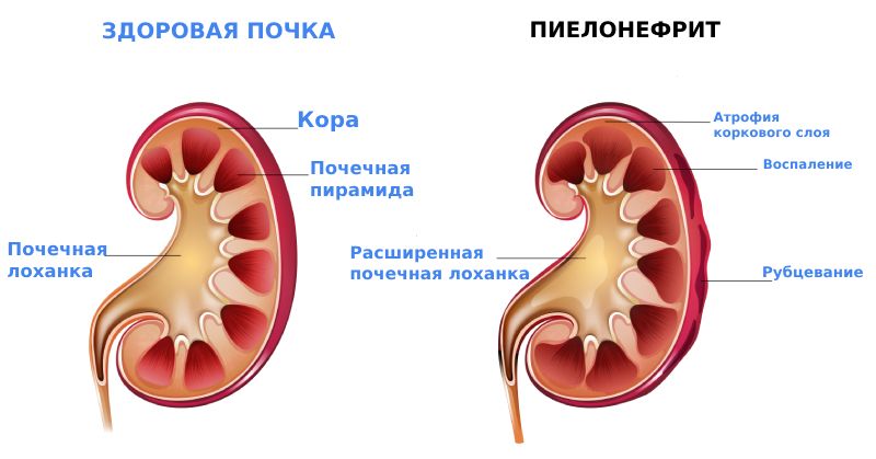 Острый пиелонефрит почки