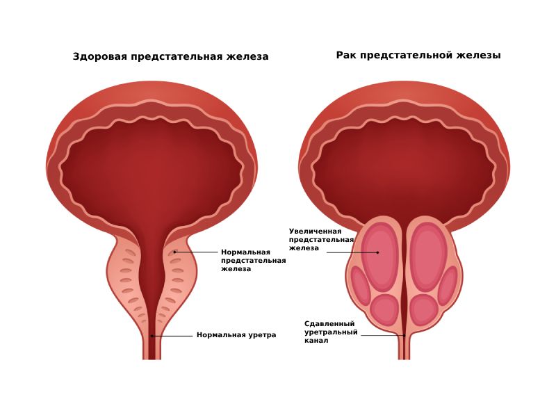 ПСА простаты у мужчин