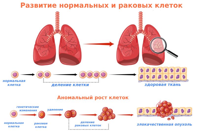 Рак легких - симптомы и признаки