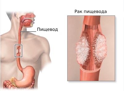 Злокачественная опухоль пищевода