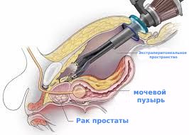 Роботическая (робот-ассистированная лапароскопическая) простатэктомия