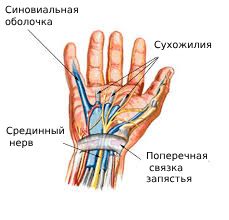 Синдром запястного канала