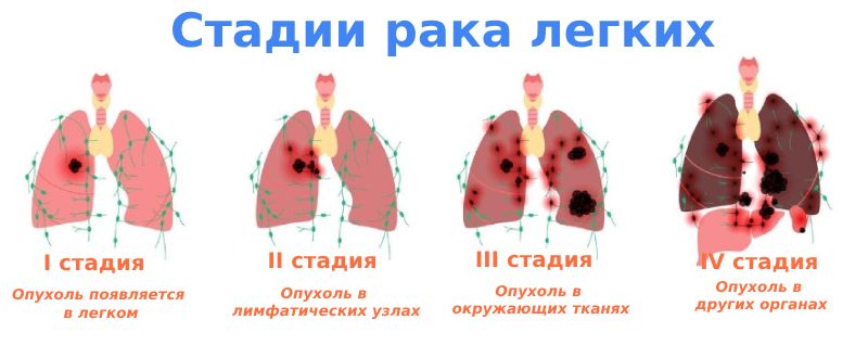 Стадии рака легких