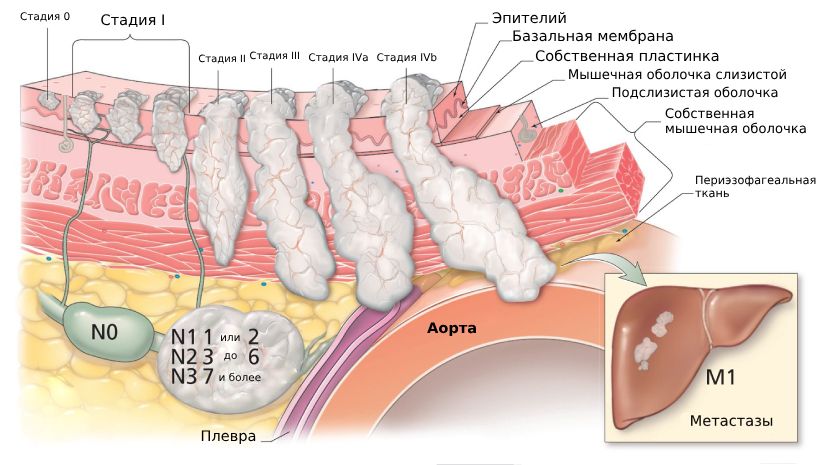 Cтадии рака пищевода