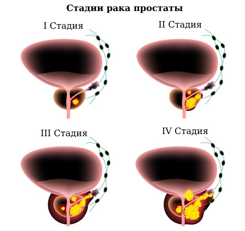 Рак предстательной железы 1, 2, 3, 4 степени