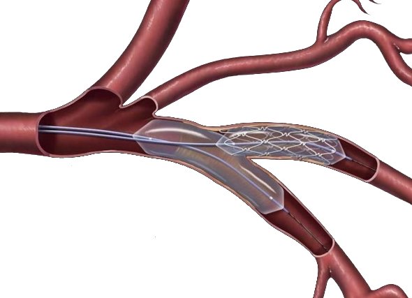 Стент в подвздошной артерии - операция