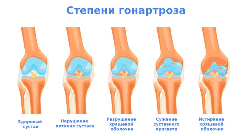 Гонартроз коленного сустава степени