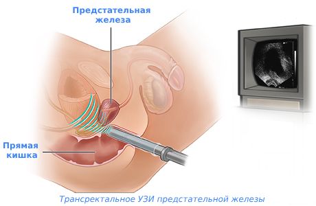 Анальная трещина