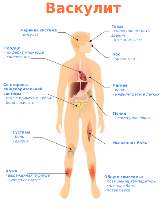 Васкулит симптомы