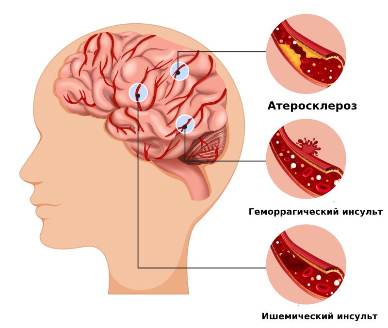 Виды инсульта