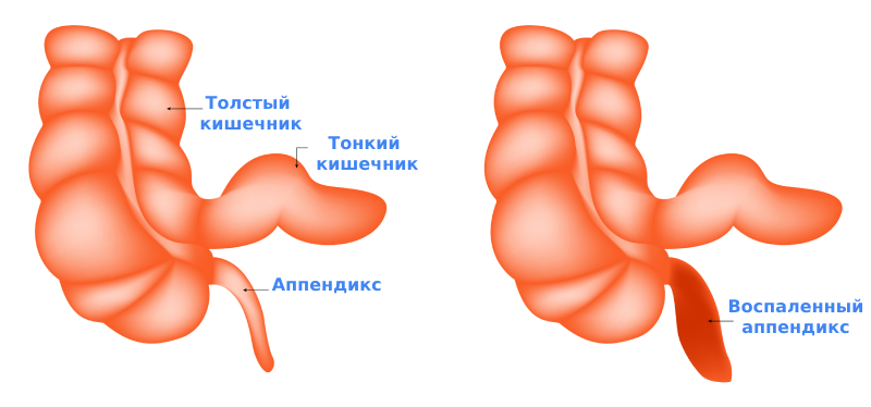 Боль при аппендиците