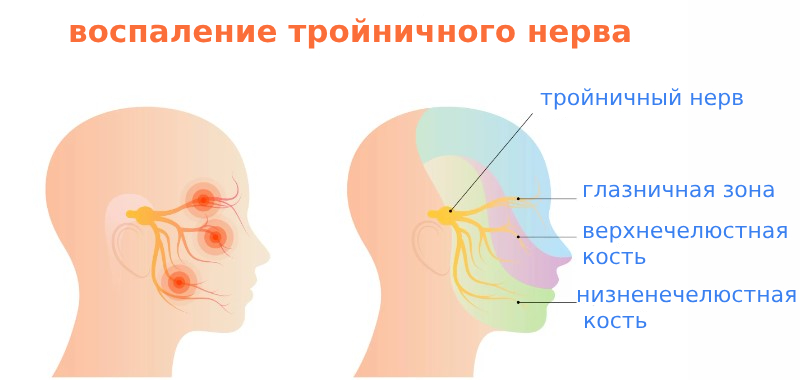 Воспаление тройничного нерва