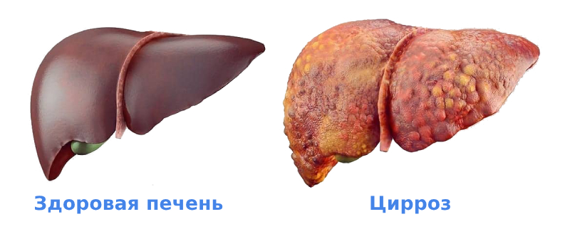 Цирроз печени симптомы Цирроз печени симптомы
