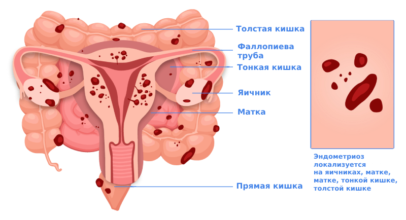 Эндометриоз кишечника симптомы Эндометриоз кишечника симптомы